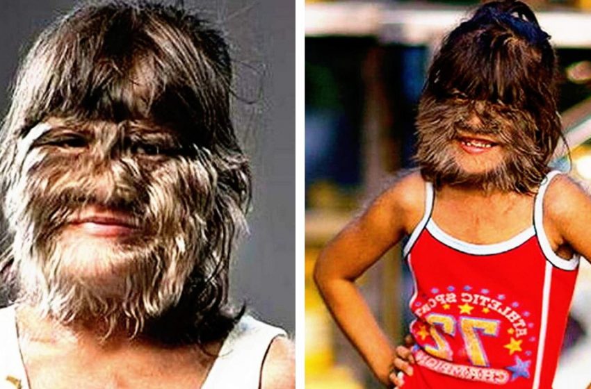  Най-косматото момиче на планетата реши да премахне косата от лицето си. Ето как изглежда днес.