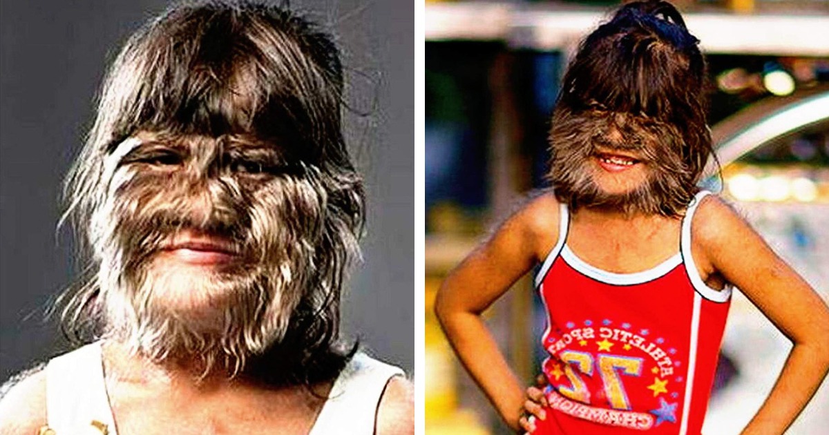 Най-косматото момиче на планетата реши да премахне косата от лицето си. Ето как изглежда днес.
