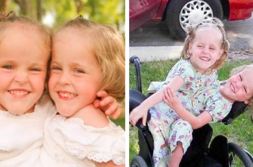  Тези сиамски близнаци бяха разделени, когато бяха на 4 години: Как се справят сега?