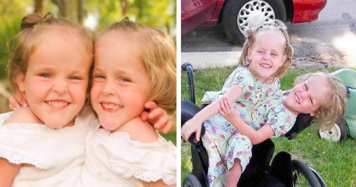 Тези сиамски близнаци бяха разделени, когато бяха на 4 години: Как се справят сега?