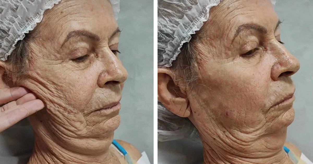 “Тя е непознаваема след пластична хирургия”: Стара дама се превърна в млада красавица!
