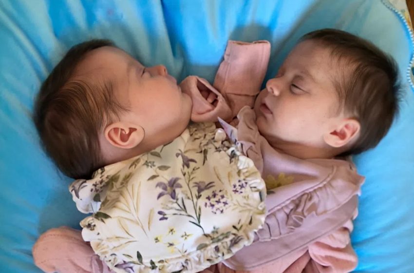От слепени в гърдите до щастливи деца: Разделените близнаци 3 години по-късно — вижте техните снимки.