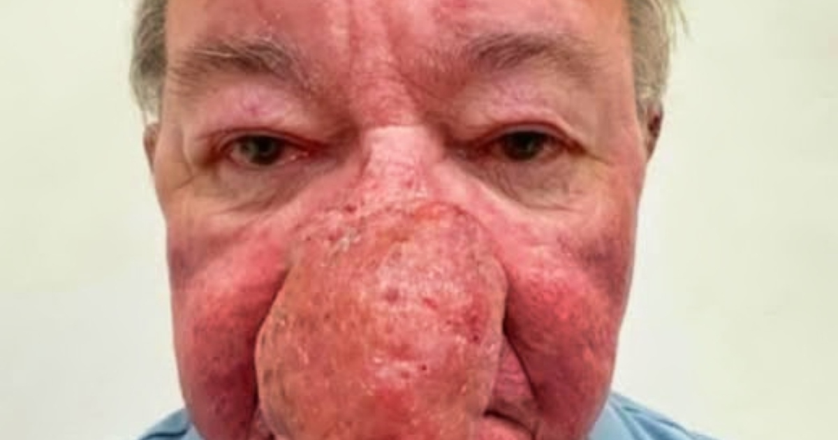 Мъж с изключително голям нос изуми всички след операцията!: Вижте снимките!